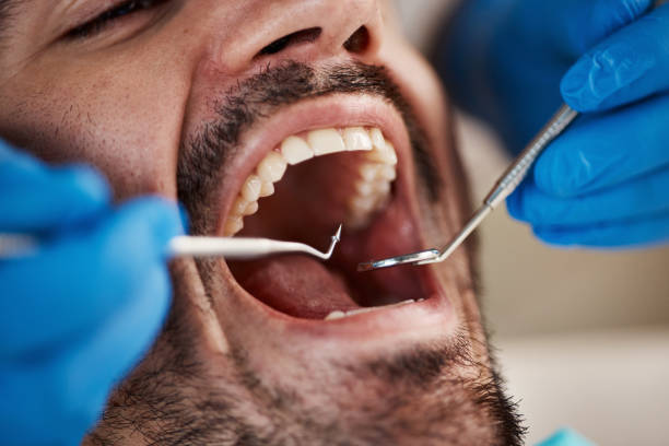 Best Emergency Dentist for Lost Fillings or Crowns in Lauderdale Lakes, FL